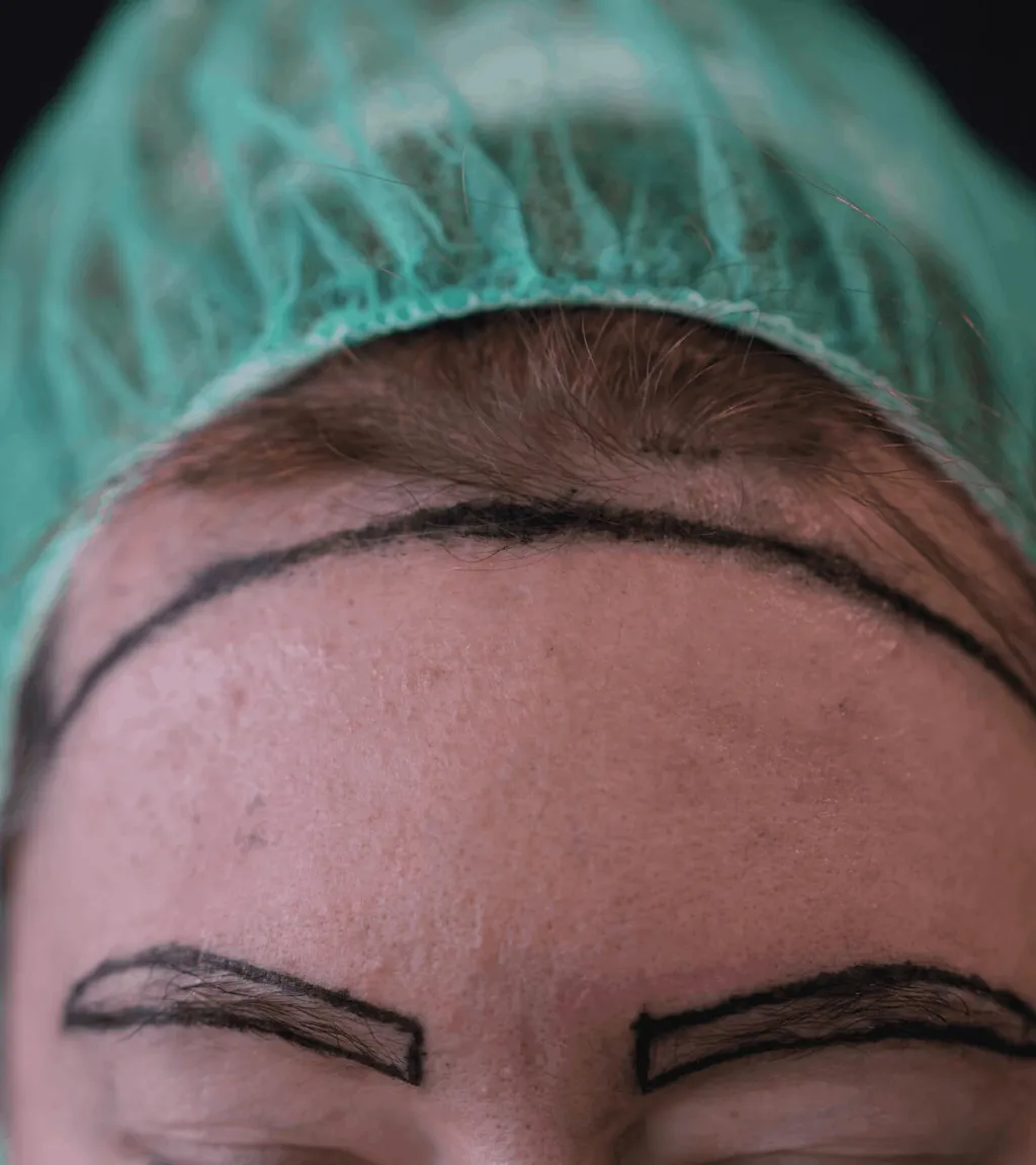 Augenbrauentransplantation