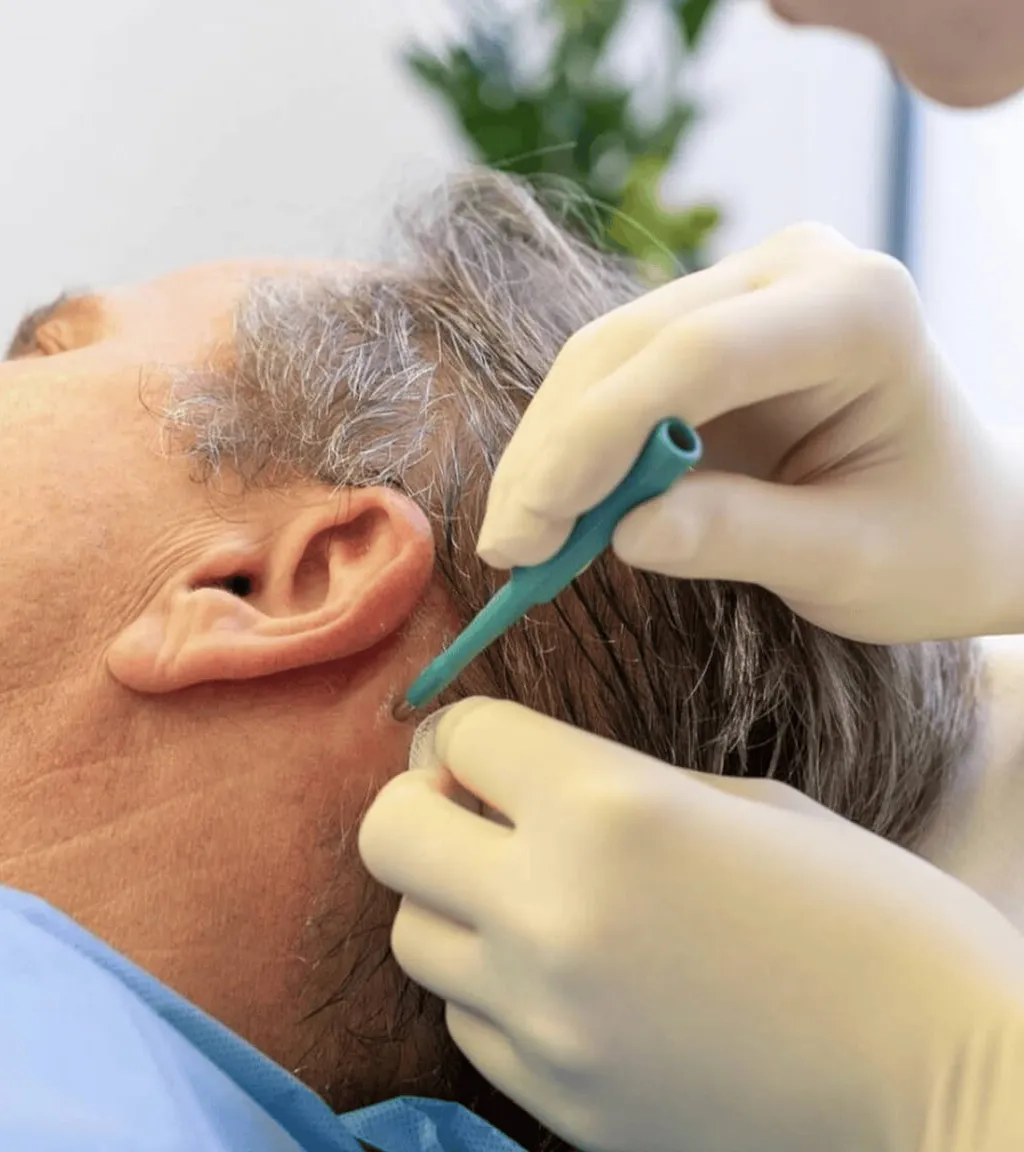 Fibroblast-Eigenstammzelltherapie