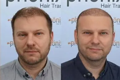 Haartransplantation Vorher Nachher – vollständige Wiederherstellung bei Norwood V–VI, Phönix Hair Trans Dortmund