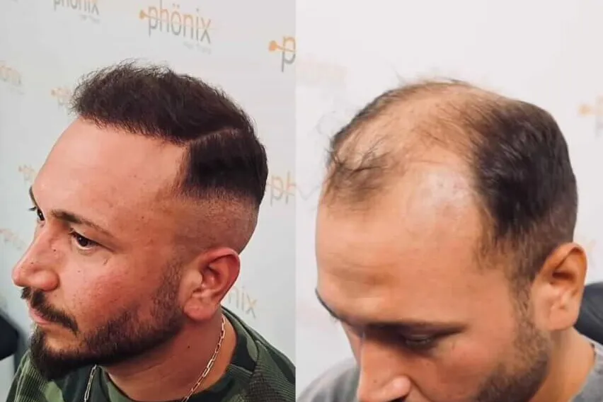 Haartransplantation Geheimratsecken Vorher Nachher – natürliche Haarlinie und Haarverdichtung, Phönix Hair Trans Dortmund