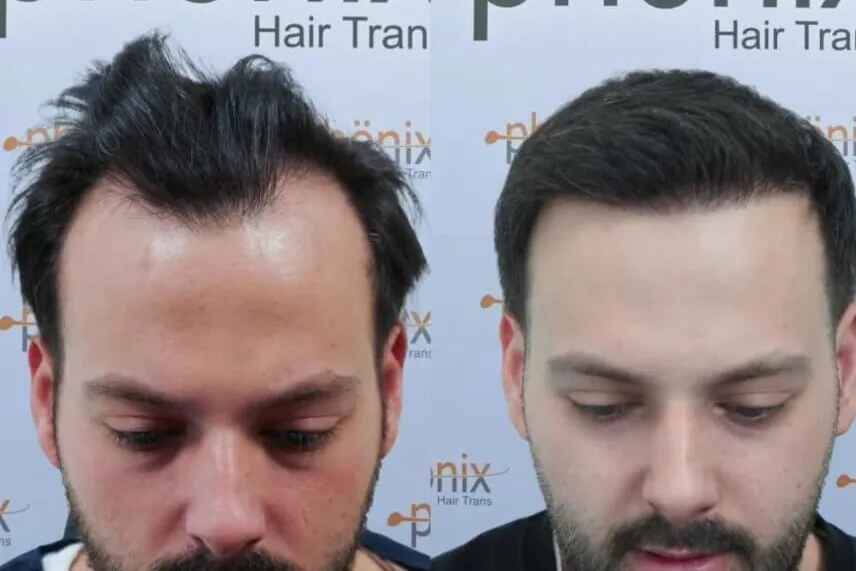 Haartransplantation 4 Monate nach dem Eingriff – sichtbares Haarwachstum und dichte Haarlinie, Phönix Hair Trans Dortmund