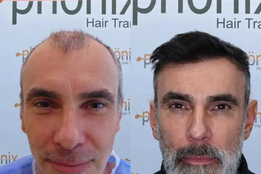Haartransplantation Gesamtrekonstruktion Vorher Nachher – von vollständiger Glatze zu natürlichem Haar, Phönix Hair Trans Dortmund