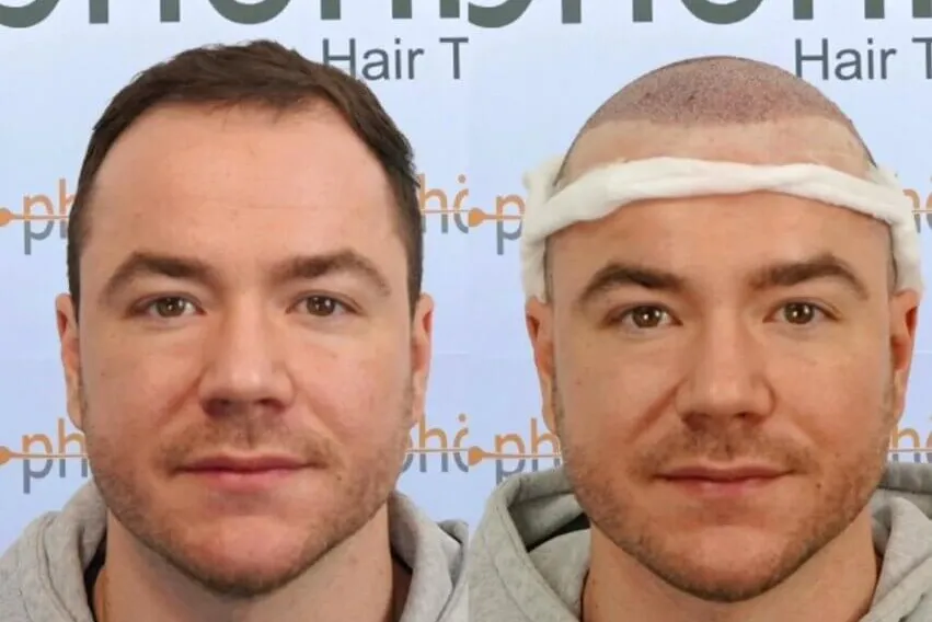 Haartransplantation direkt nach dem Eingriff – neue Haarlinie sofort erkennbar, Phönix Hair Trans Dortmund