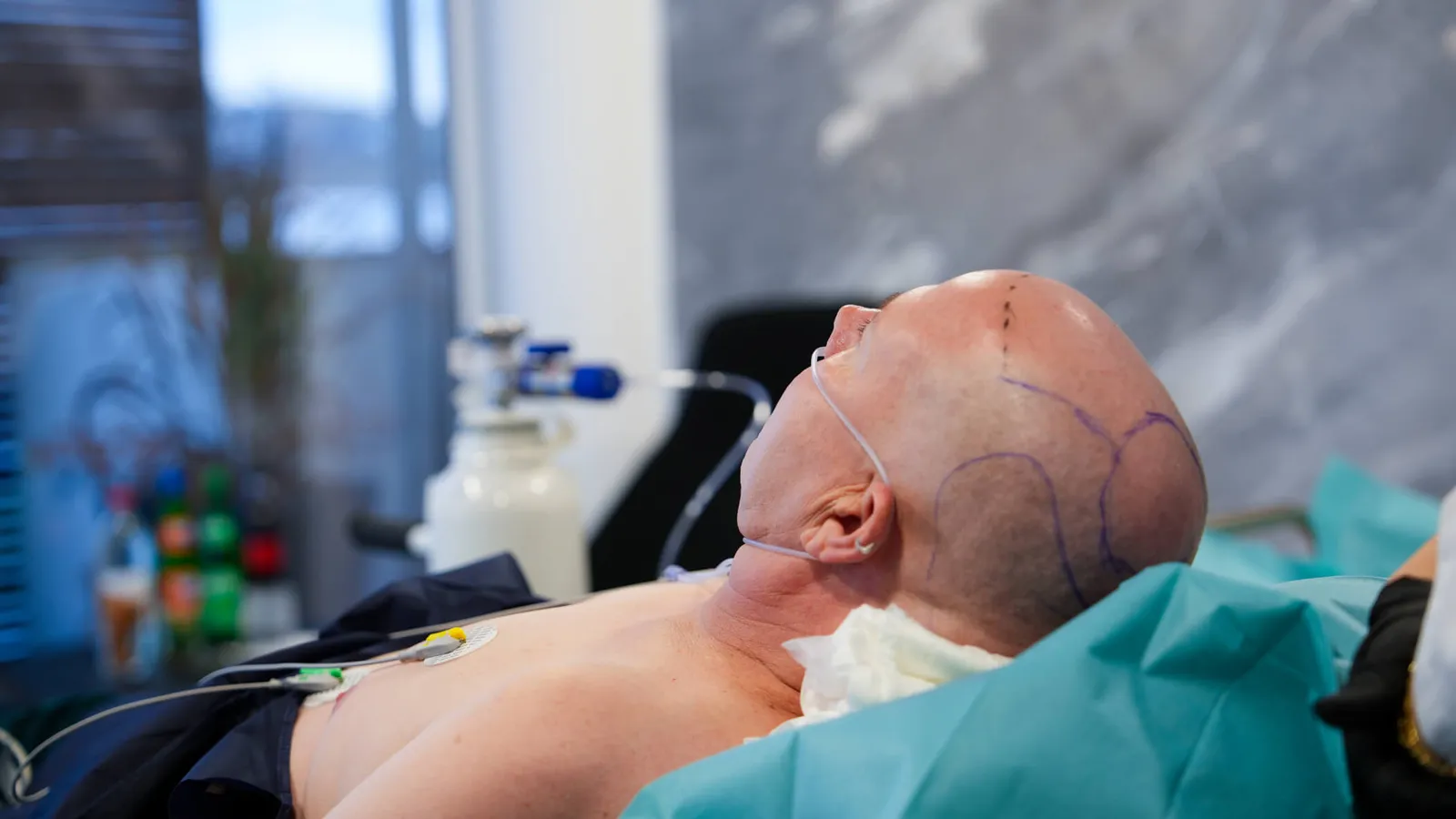Sleep Deep: Die schmerzfreie Methode – Führende Haartransplantation in Europa
