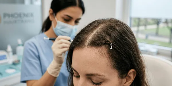 Haartransplantation bei Frauen: Hilfe bei dünner werdendem Haar und hoher Stirn