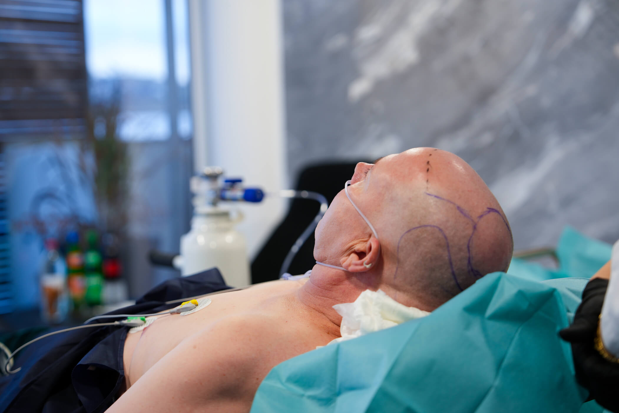 Sleep Deep: Die schmerzfreie Methode – Führende Haartransplantation in Europa