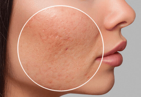 Aknenarben-Behandlung