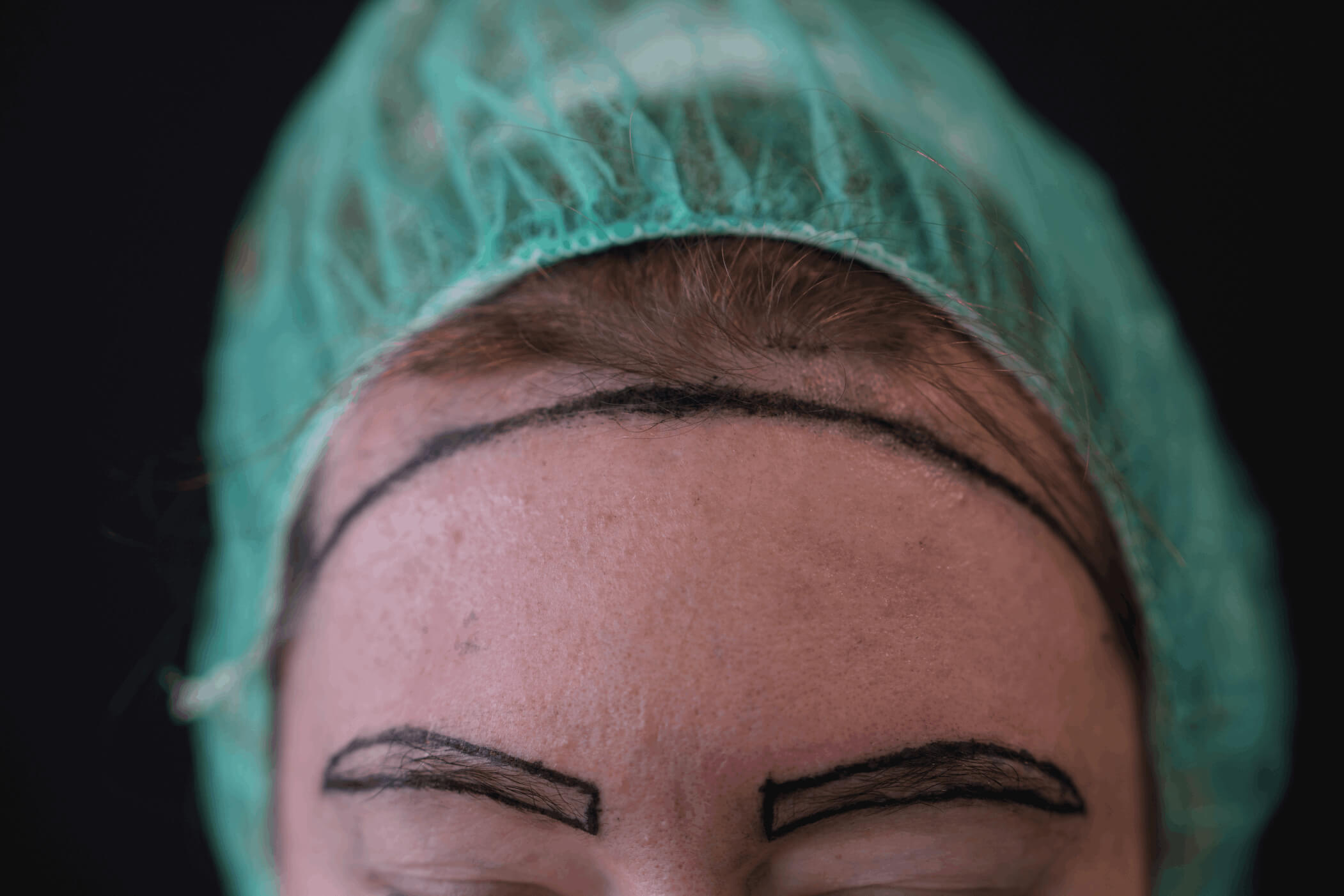 Augenbrauentransplantation