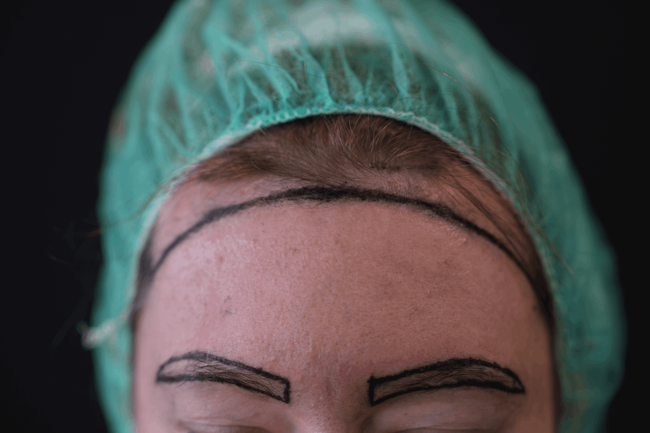 Augenbrauentransplantation