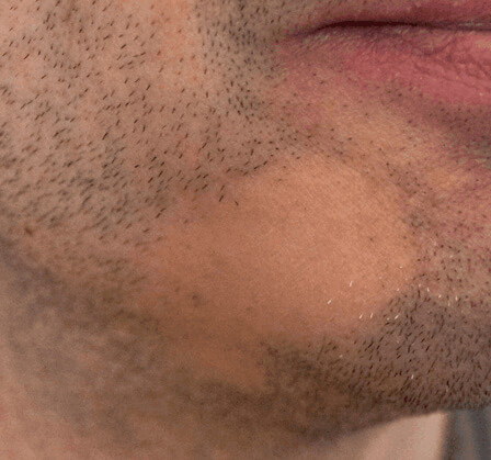 Vorher Barttransplantation