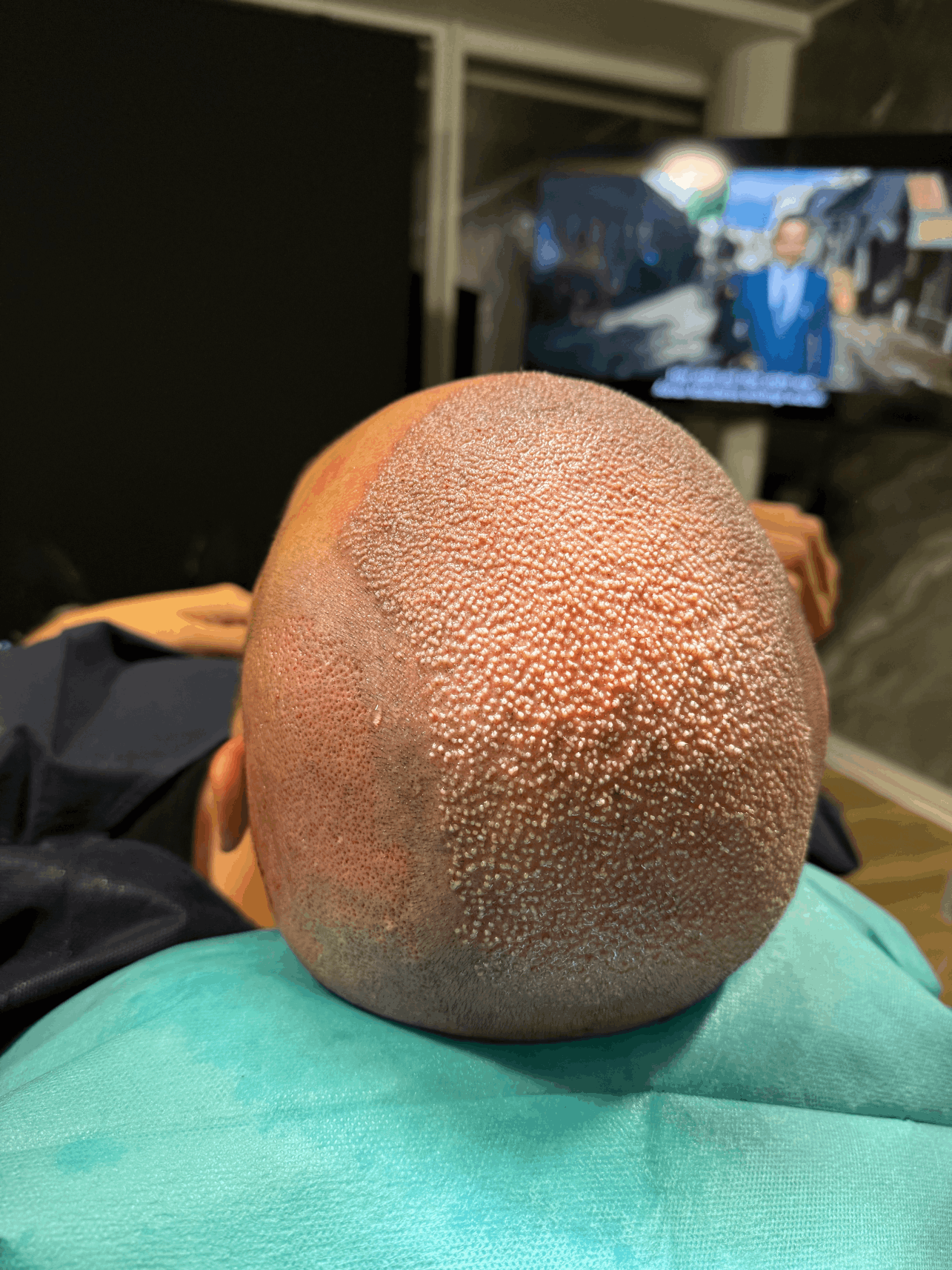 FUE Haartransplantation