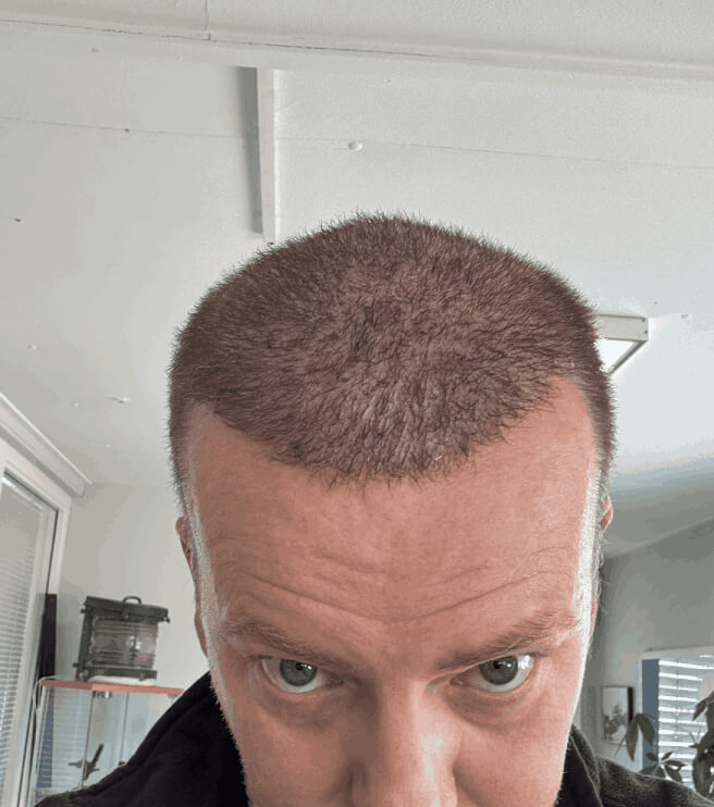 Nachher Bild Haartransplantation 1 Monate