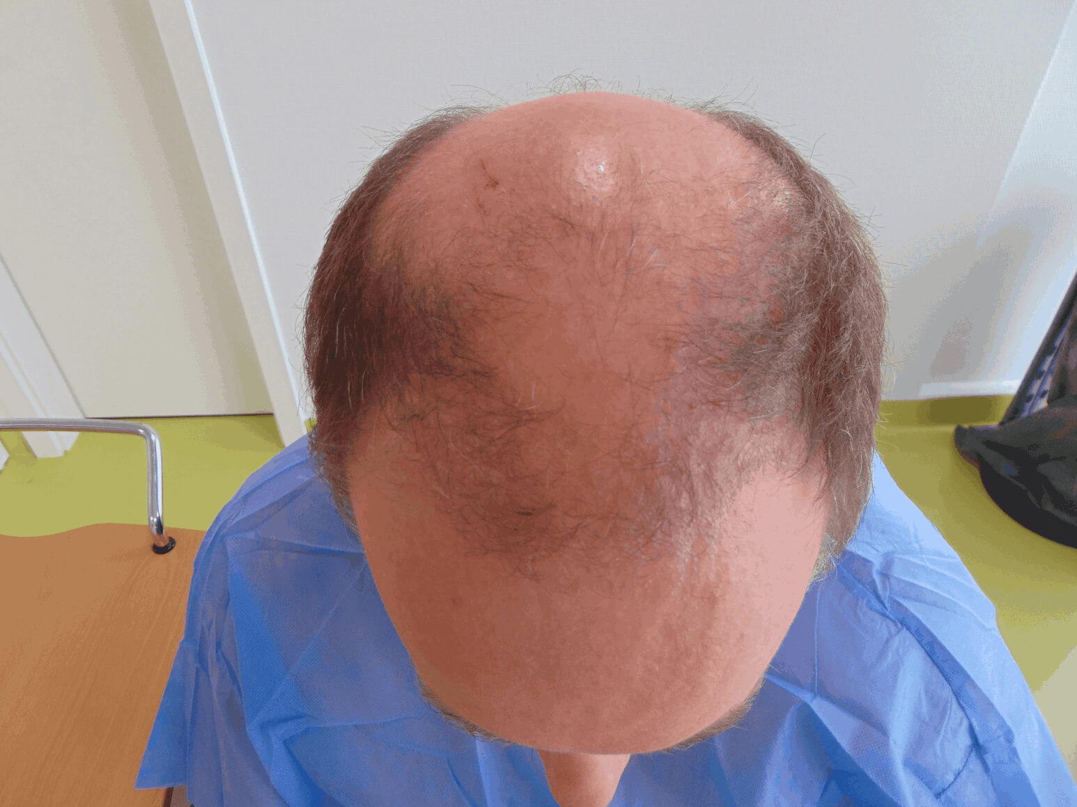 Vorher Bild Haartransplantation 1 Monate