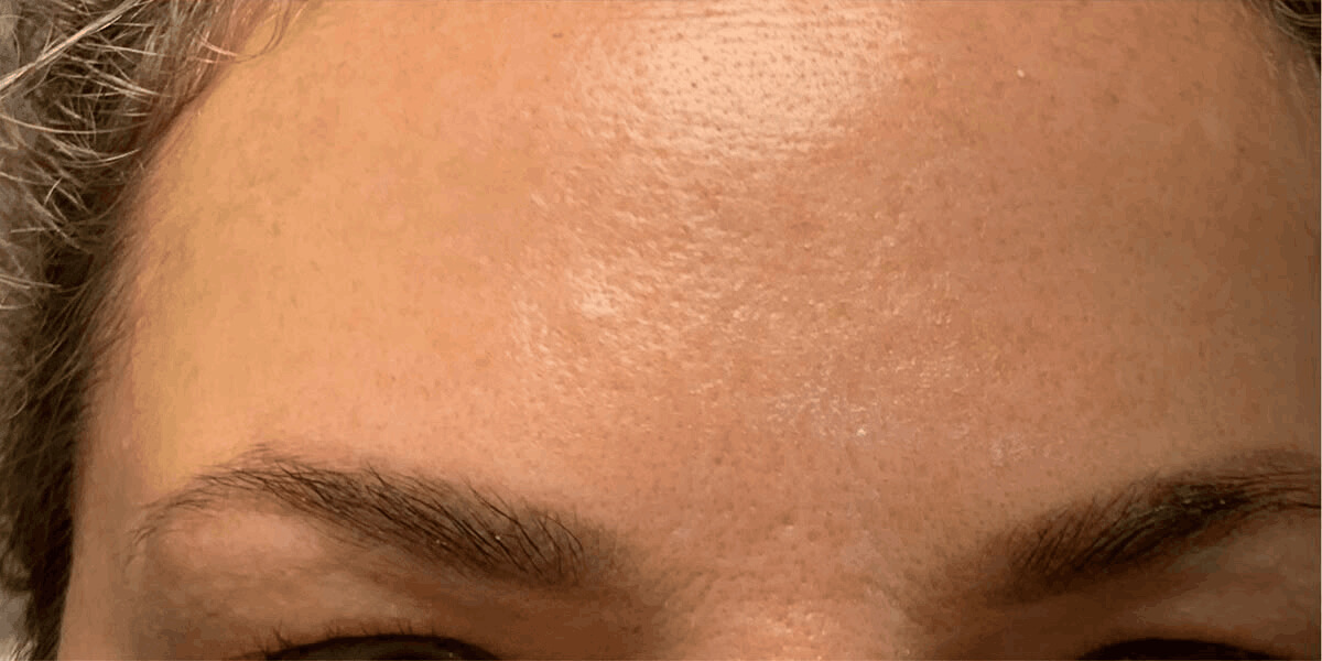 Nachher-Bild Botox