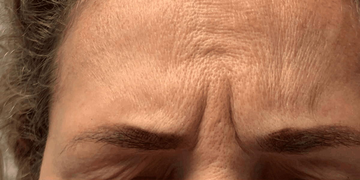 Vorher-Bild Botox