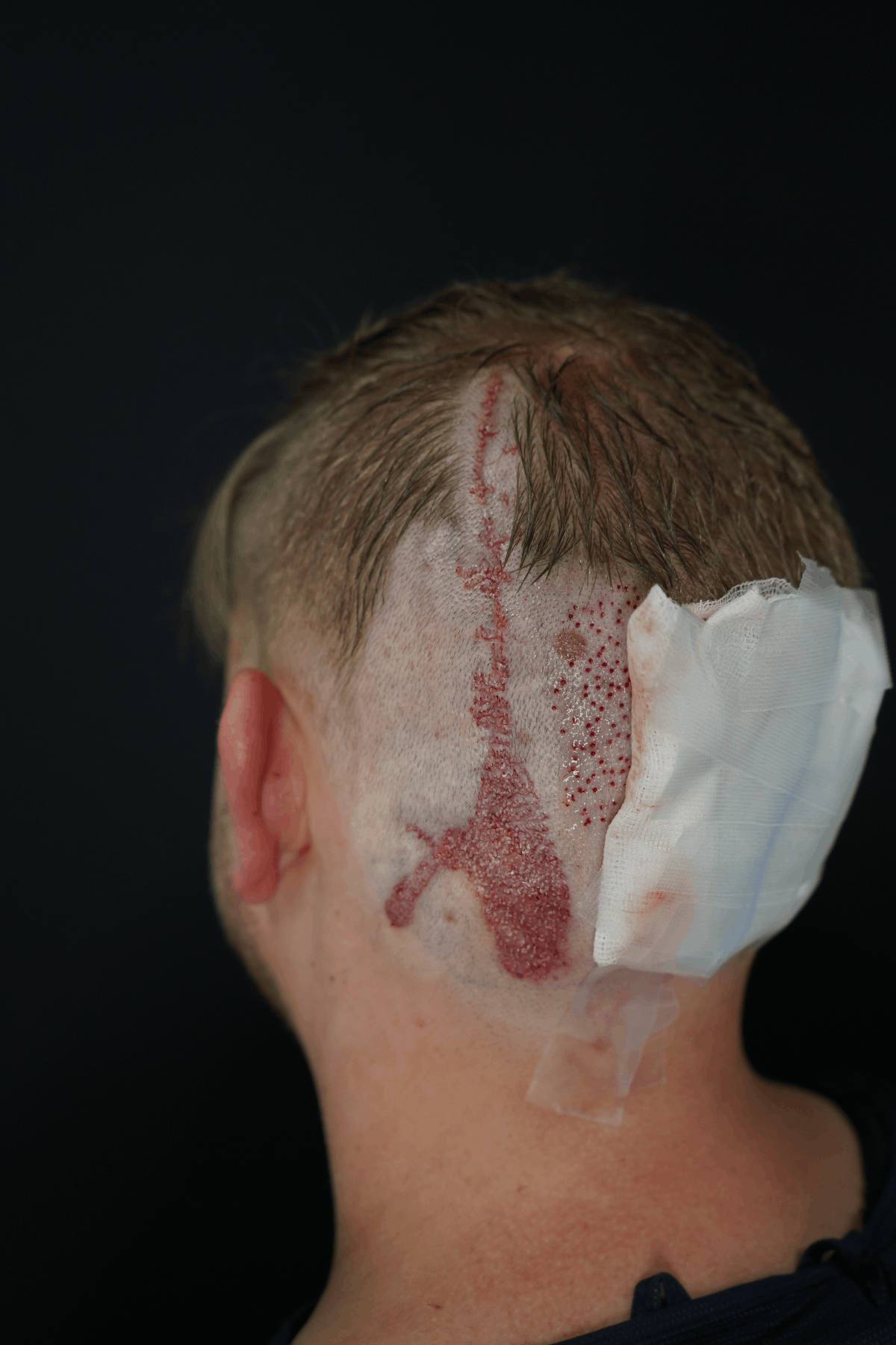 Narben-Haartransplantation (bei Unfall-, Brand- oder Operationsnarben)