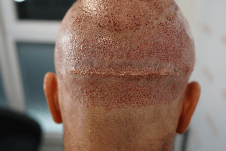 Nachher Narben-Haartransplantation 9 Monate