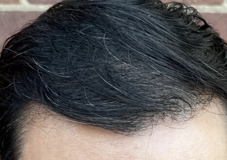 Nachher Saphir FUE Haartransplantation 6 Monate