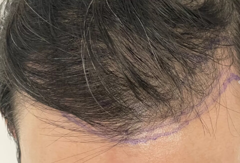 Vorher Saphir FUE Haartransplantation 6 Monate